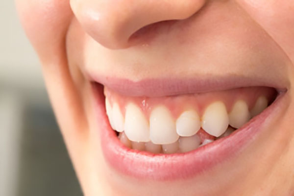 Reasons To Get  Teeth Whitening Trays From A Dentist