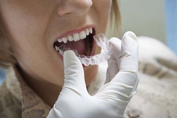 Questions For An Adult Invisalign Dentist In Albuquerque